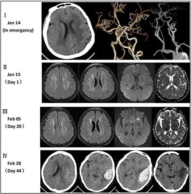 The challenge of managing ischemic stroke in brucellosis: a case report